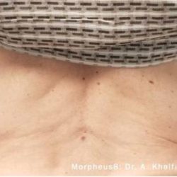 Morpheus8 Before & After Patient #1626